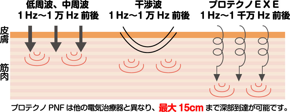 プロテクノＥＸＥと他の治療器との違い